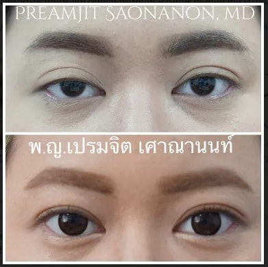 All About Ptosis