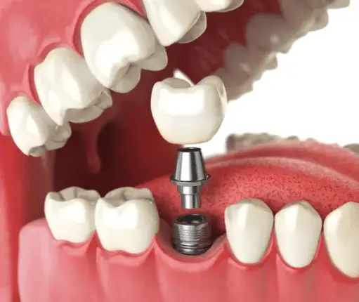 Is it worthy to get dental implants?