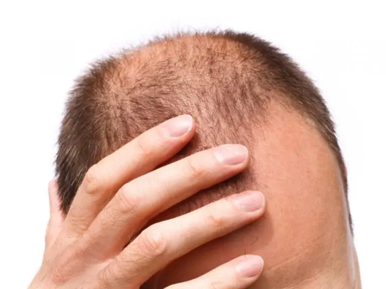 Is Hair loss and stress-related | what is the answer