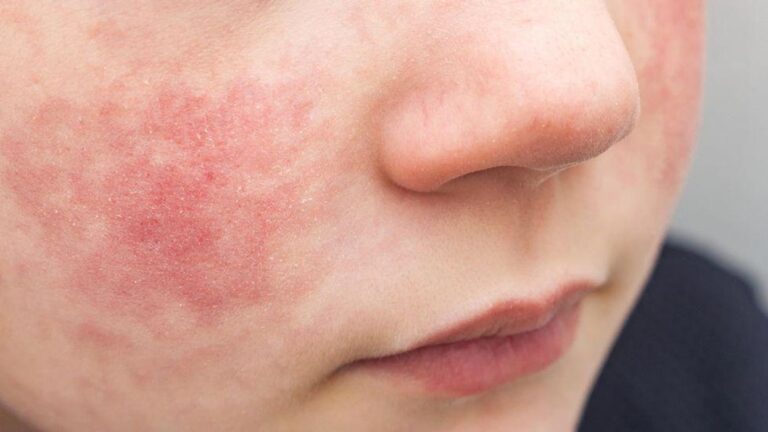 What Cream Will Remove Psoriasis Redness?