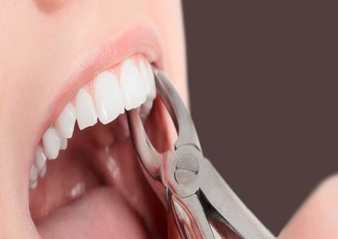 Tooth extraction in Gurgaon: What to Consider When Getting it Done