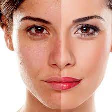 Fight Signs Of Aging With Dermal Fillers