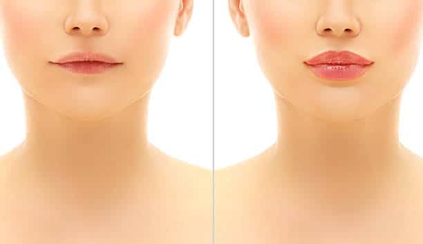 The Cost of Lip Injections in New Jersey