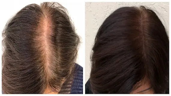 An Insight into Micropigmentation of the Scalp