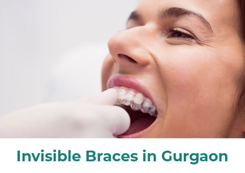 Here is All You Need to Know About Invisible Braces