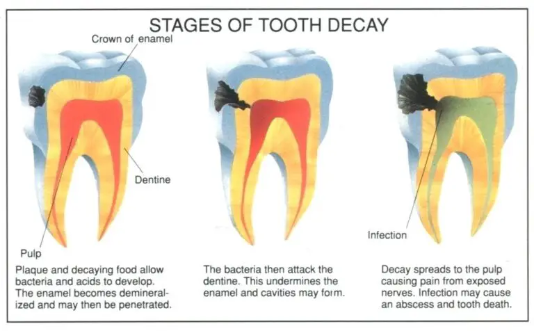 Things To Know About Root Canal Treatment in Gurgaon