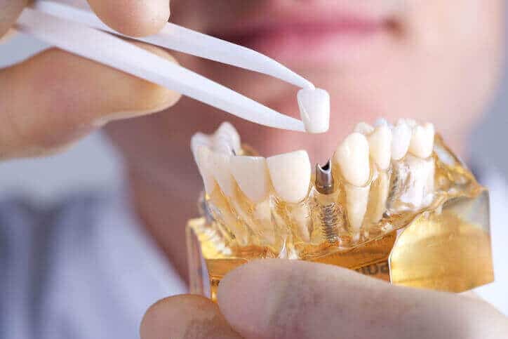 What Are The Benefits Of Dental Implants And How Costly it is?