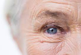 Wrinkles Types of Wrinkles Causes, Pictures, Cure