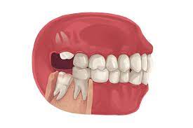 Practical ways to handle impacted wisdom teeth