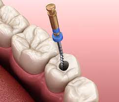 How Do I Know If I Need A Root Canal Treatment?