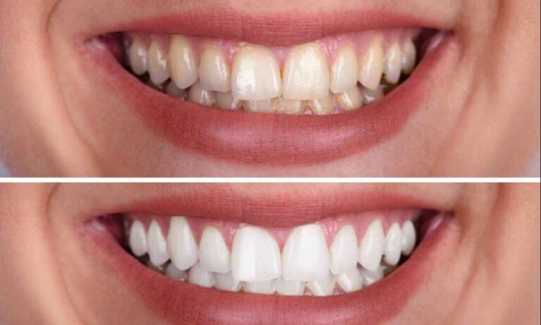 How Does Teeth Whitening Work?