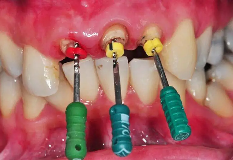 Root Canal on Front Tooth – Is It worthy to Try