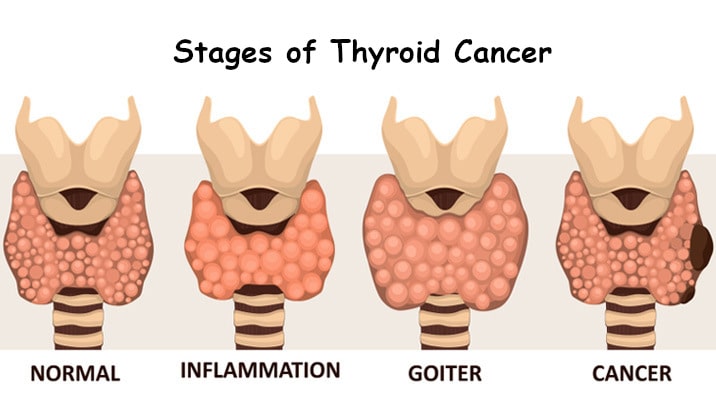 Who is at High Risk for Thyroid Cancer?