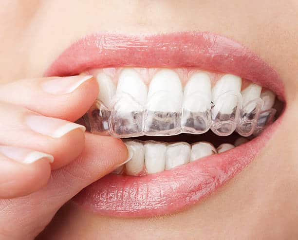 How To Improve The Effectiveness Of The Clear Aligners Treatment?