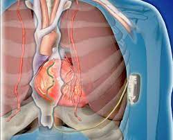 Subcutaneous Implantable Defibrillator System Market Opportunities, Size, Share, And Forecasts 2028