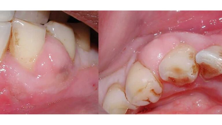 Is Composite Filling Good For Teeth?