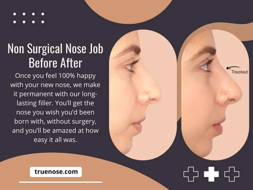 Non Surgical Nose Job Before After-e7ae0f82