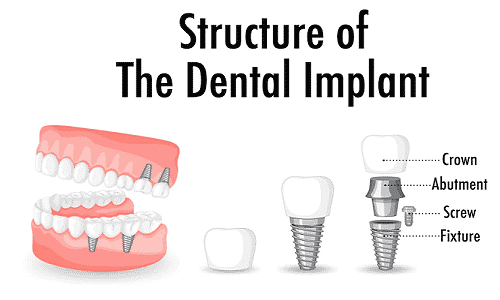 Structure of dental implants-6471e330