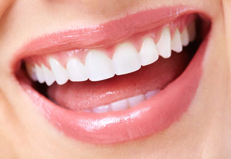 Maintaining White Teeth After Teeth Whitening