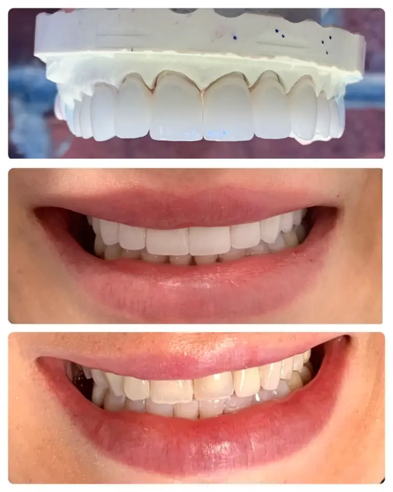 What Are Types Of Teeth Whitening Options?