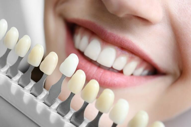 Sharing a Guide of Professional Teeth Whitening