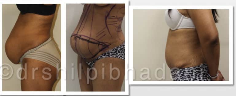 Tummy Tuck Surgery Cost in Gurgaon