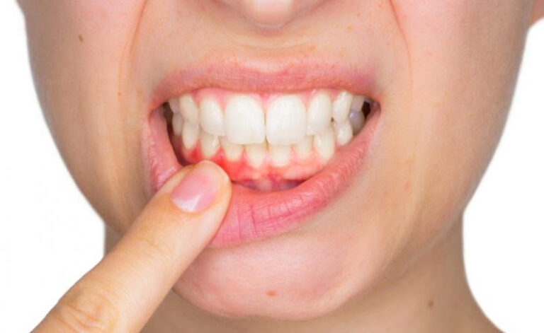 Can Periodontitis Be Cured?