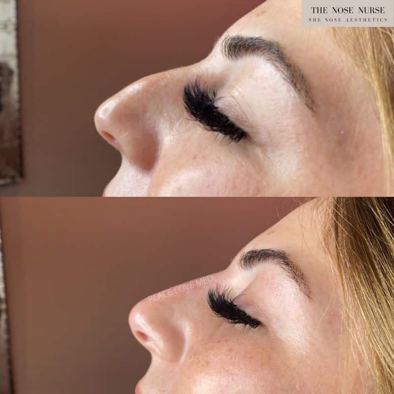 Non Surgical Nose Job Before and After