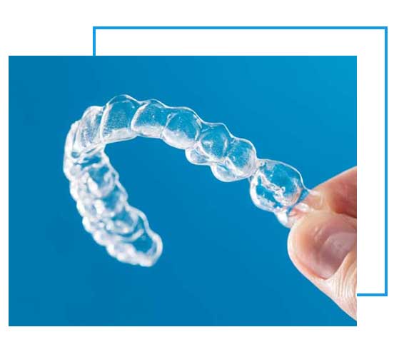 What Are The Features Of Clear Braces?