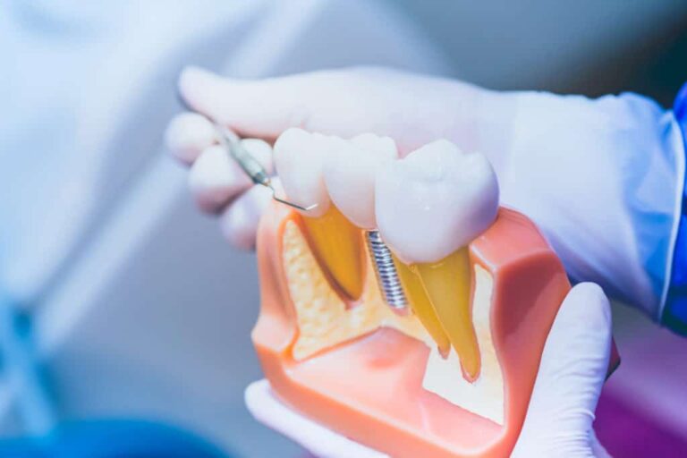 How to Determine Your Dental Implant Cost?