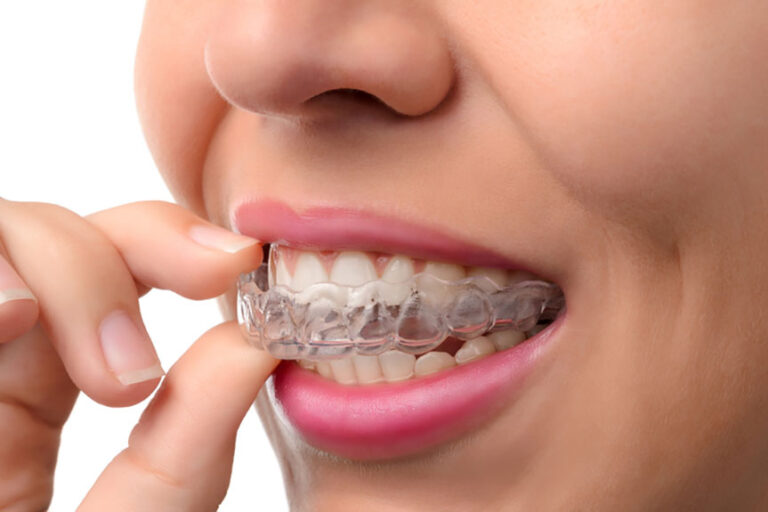 Everything you Need to Know About Invisible Braces in St Albans