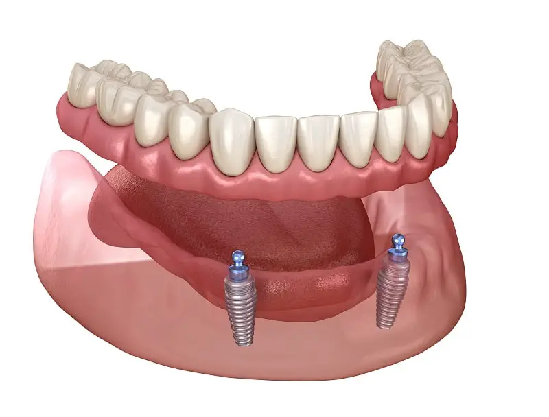 mini implant dentures Jasper AL-29a2f293