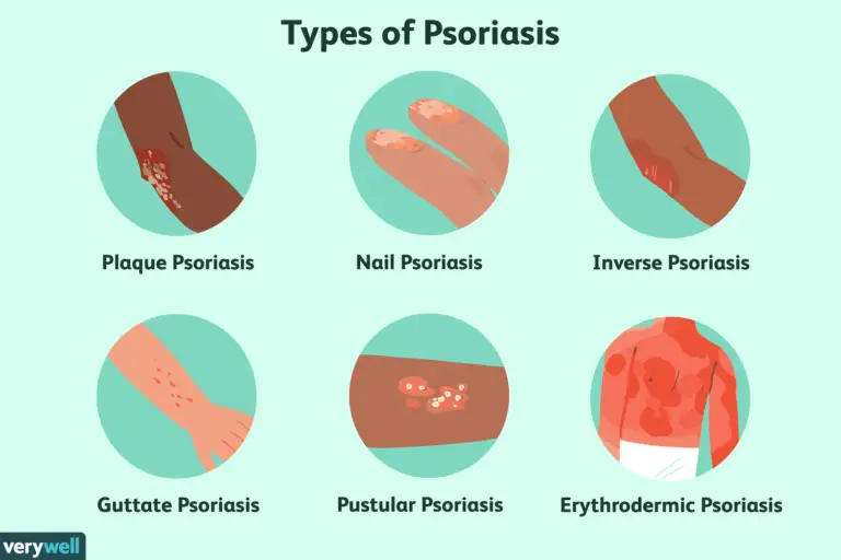 What are the Different Types of Psoriasis?