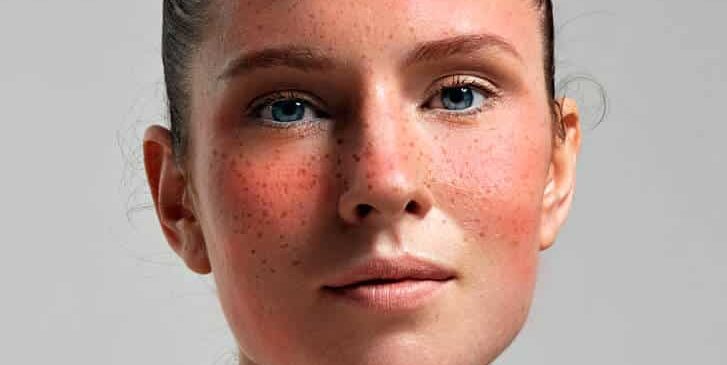 The 4 Stages of Rosacea and Its Treatment