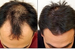 Hair Transplant in Dubai & UAE