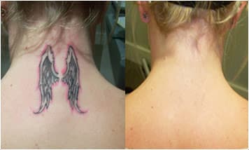 WHAT IS THE GENERAL COST OF TATTOO REMOVAL?