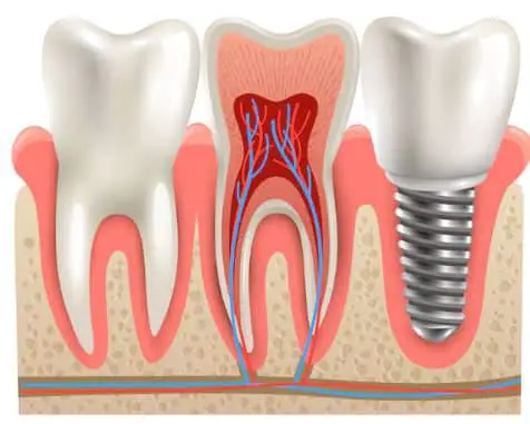 7 Things To Keep In Mind When Planning Your Dental Implants