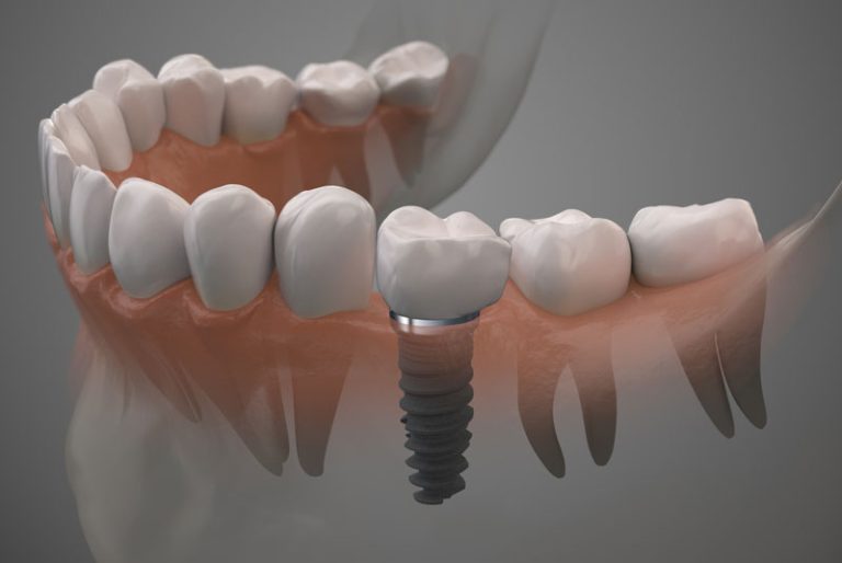 Dental Implants Explained in Baton Rouge La