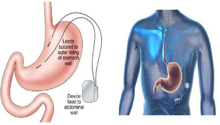 Gastric Electrical Stimulation Systems Market Size, Growth, Regional Outlook, and Forecast – 2030