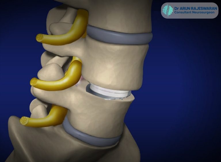 Lumbar Disc Replacement Surgery: Dr Arun Rajeswaran