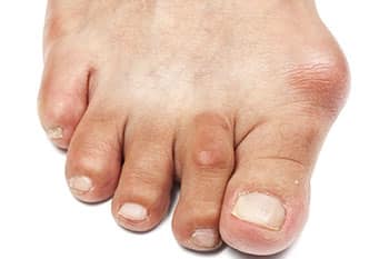 Is Fixing A Bunion Effective?