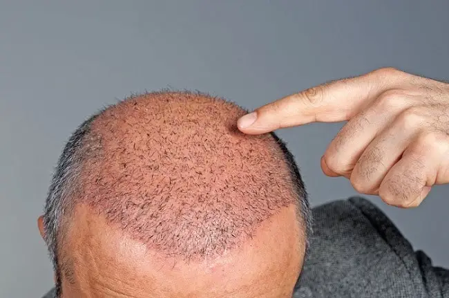 An Extensive Guide To Hair Transplant Aftercare & Recovery