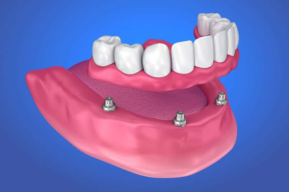 implant supported dentures panacea fl-dd121ca8