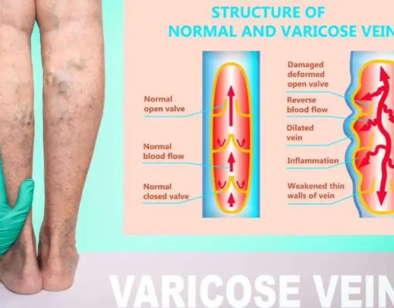 Learn More About Vein Doctors And Vein Disorders They Treat