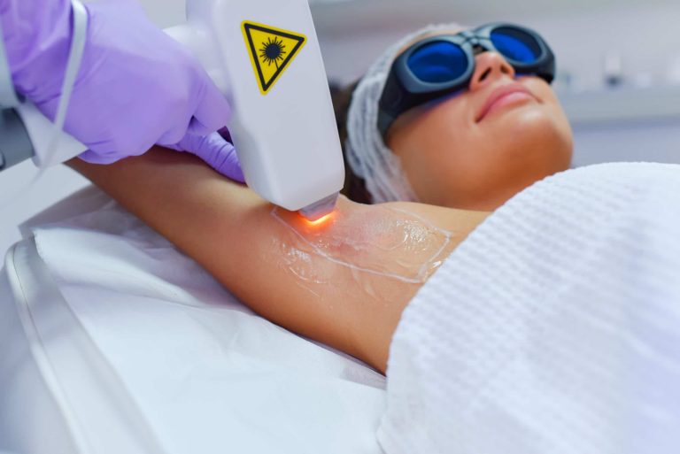 LASER HAIR REMOVAL – ANSWERS TO FREQUENTLY ASKED QUESTIONS