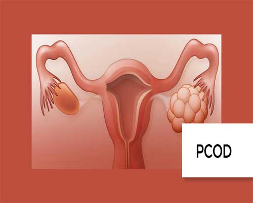 PCOS: Understanding the Causes, Symptoms, and Treatment Options