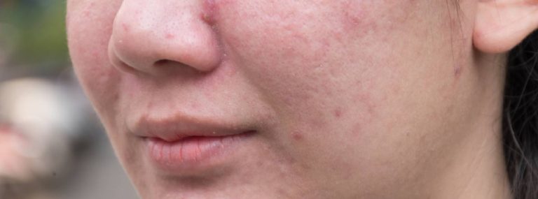 Hormone Imbalance and Acne: An overview