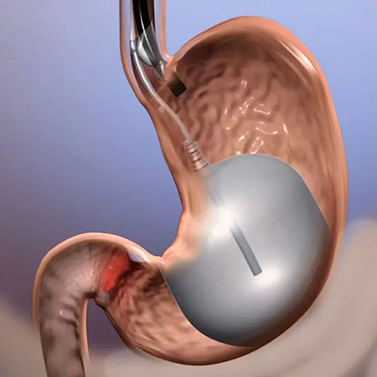 How Gastric Balloons Help You Lose Weight?