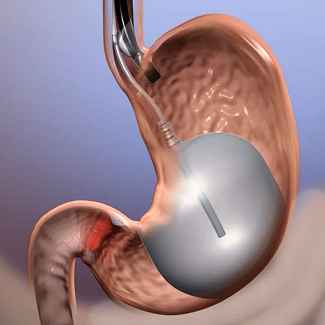 How Gastric Balloons Help You in Losing Weight.