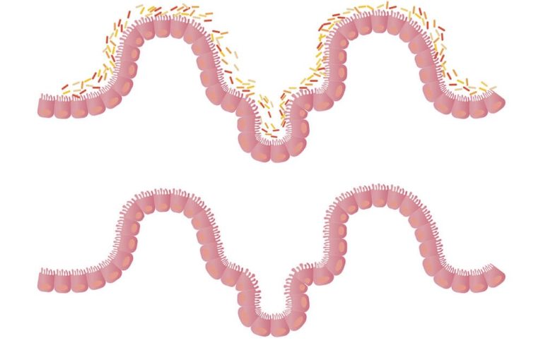 Metabolite Analysis: Intestinal Bacteria can Predict Obesity